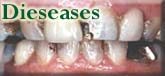 Dental Dieseases