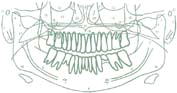 Ortho Pantomo Gram (OPG)